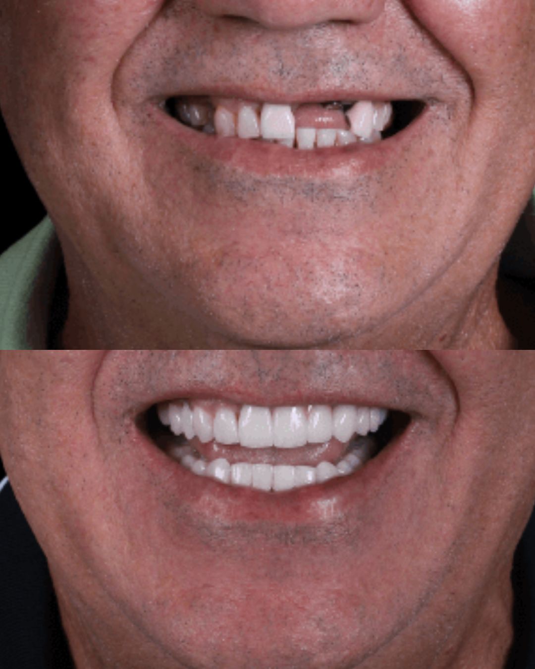 Sorriso reconstruído com facetas e próteses